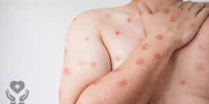 Todo sobre la viruela del mono - Síntomas y prevención.